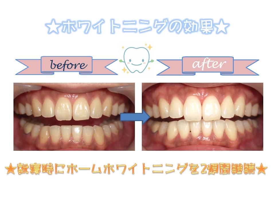ホワイトニング 低価格 ホーム 簡単 白い歯 安全 手軽 | 三田 赤羽橋